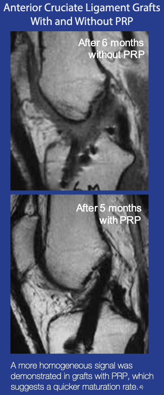 PRP - Platelet-Rich Plasma for ACL Injury