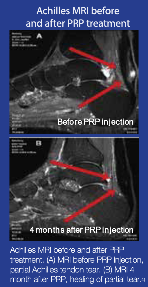 PRP Platelet-Rich Plasm for Achilles Tendinosis